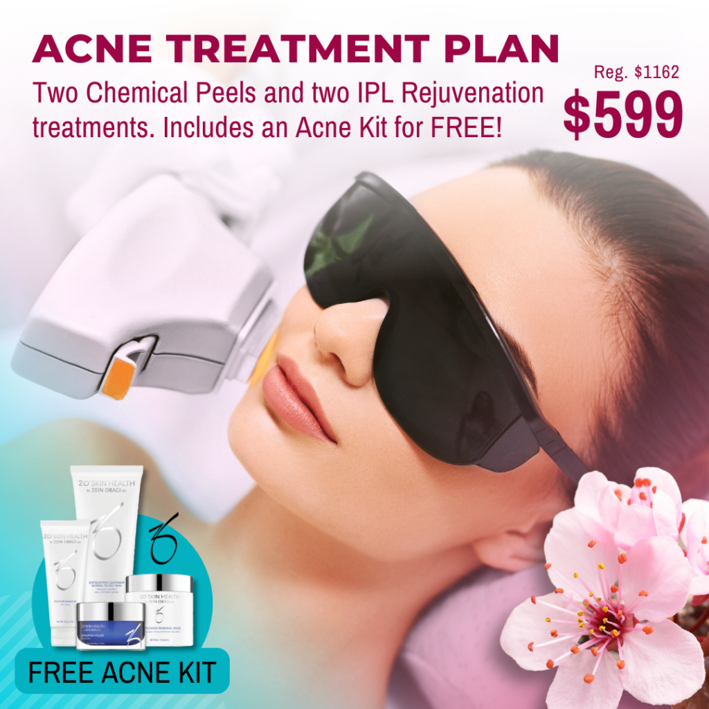 April Special: Acne treatment plan for $599